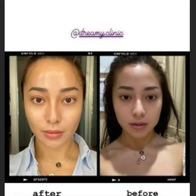 Tampil Beda, Nikita Willy Unggah Foto Sebelum dan Sesudah  Perawatan Botox