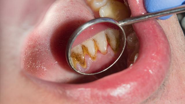 Cara menghilangkan karang gigi yang sudah mengeras secara alami