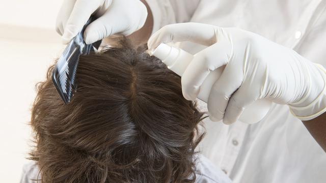 Cara Ampuh Membasmi Kutu Rambut dan Telurnya yang Bikin Kepala Gatal, Intip Yuk