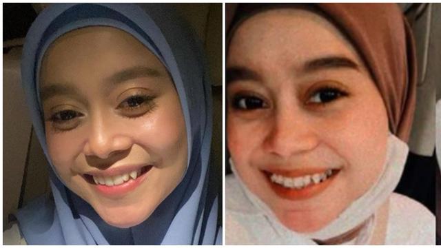 6 Beda Gaya Lesti Kejora Sebelum vs Sesudah Pakai Behel, Hilangkan Gingsul