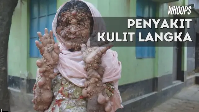 WHOOPS: Wanita Ini Dikucilkan Akibat Menderita Penyakit Langka 