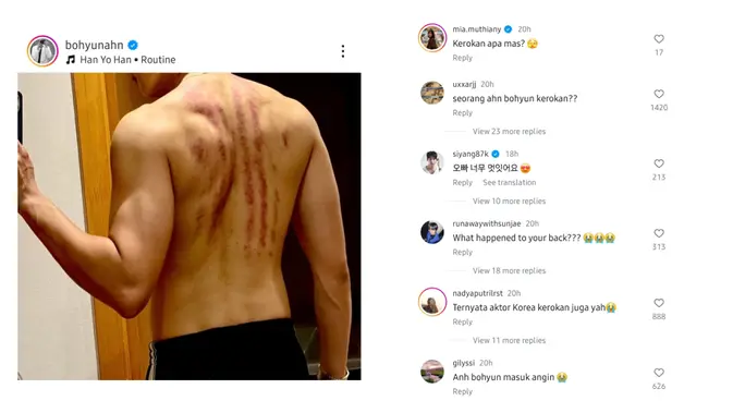 Viral Ahn Bo Hyun Pamer Punggung, Netizen Indonesia Heboh Sebut Mirip Kerokan