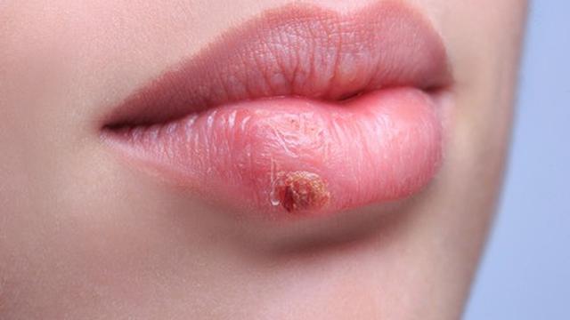 A herpes simplex okoz-e fogyást. Gyakori megbetegedések