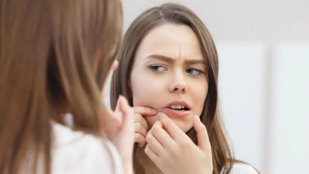 Duh jerawat ini memang menjengkelkan./Copyright shutterstock.com