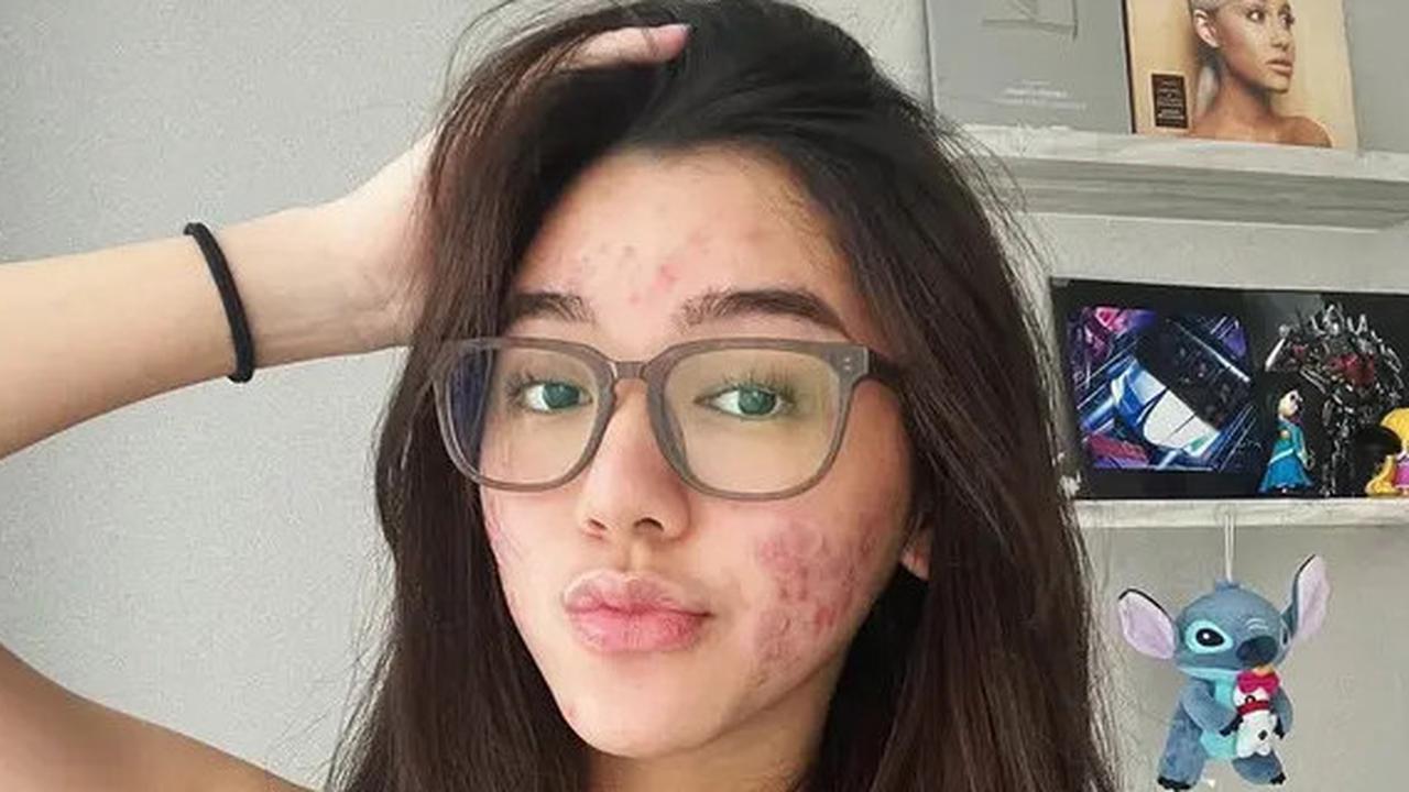 6 Potret Pede Gabriella Ekaputri dengan Wajah Penuh Jerawat, Tak Malu Foto Tanpa Makeup