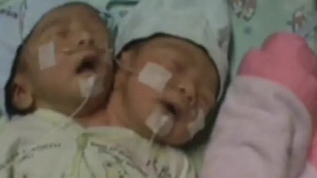 Bingung Biaya Perawatan, Orangtua Si Bayi Berkepala 2 Pasrah