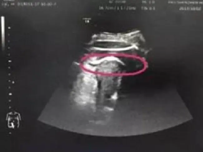 Bayi di Kandungan Ini Tendang Rahim Ibunya hingga Robek (Peking University Shenzhen Hospital)