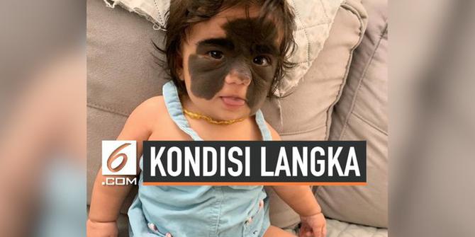 VIDEO: Bayi Ini Punya Tanda Lahir di Wajah Karena Kondisi Langka