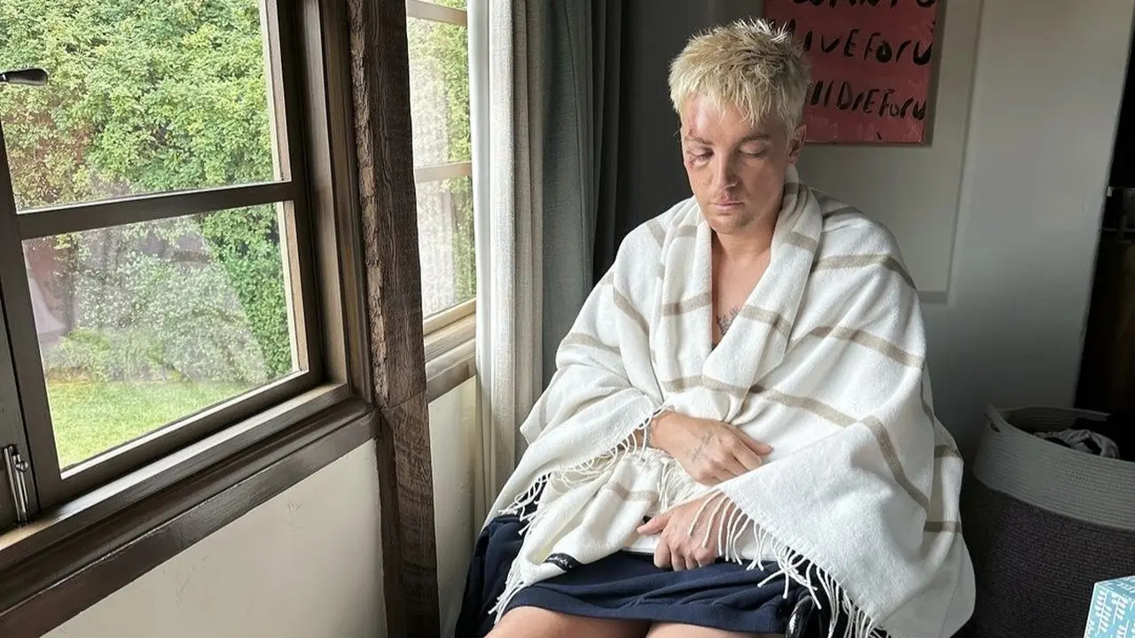 Paul Klein vokalis LANY kecelakaan. (Instagram/ pauljasonklein).