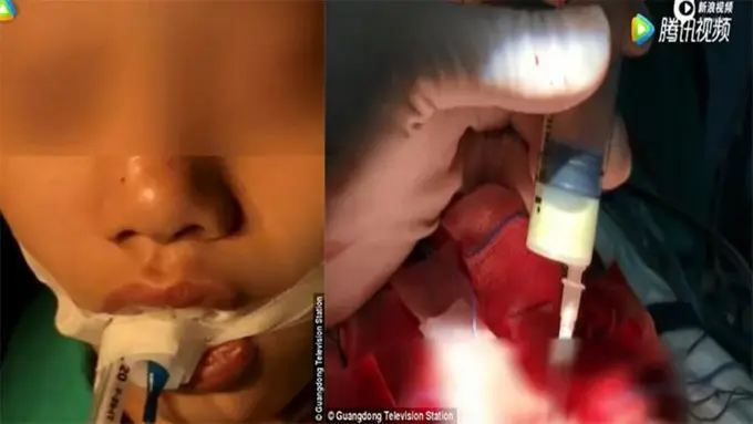 [Bintang] Gara-gara Kebiasaan Pencet Komedo, Gadis Ini Jalani Operasi Otak