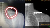 Pelajar SMP di Lampung Selatan Dibully Teman hingga Bahu Patah