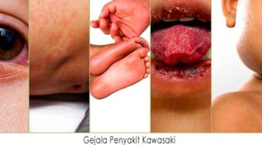 Waspadai Virus Kawasaki Landa Kesehatan Anak
