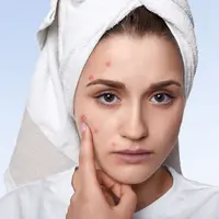 ilustrasi Cara mencegah dan fakta jerawat hormonal/pixabay