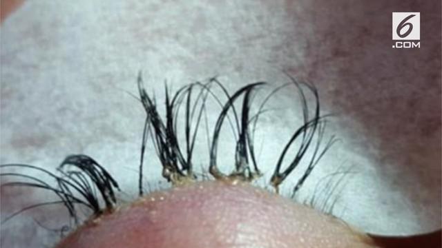 Anda yang hobi ekstensi bulu mata kini harus berhati-hati. Bila infeksi, efek yang ditimbulkan bisa berbahaya.