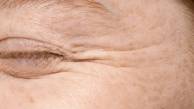 Dry Skin