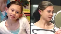 Isabelle Sterk saat kecil (kiri) dan masa kini dengan daun telinga pasca operasi. (Foto: People)