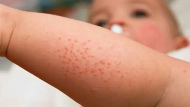 Tak Perlu Panik, Atasi Ruam Kulit Bayi dengan Langkah Ini
