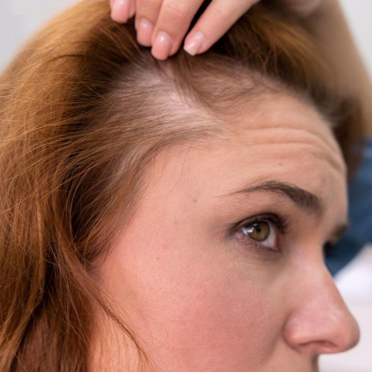 Rambut Rontok Akibat Stres? Temukan Solusi dan Cara Pencegahannya!