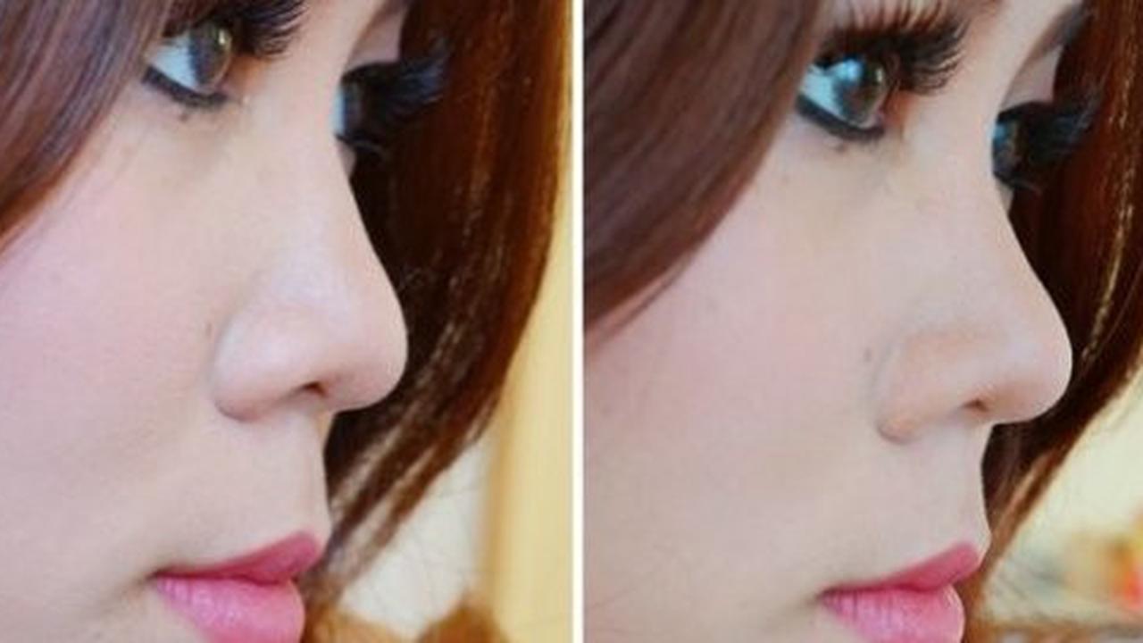 Ingin hidung mancung tanpa bedah, coba Dermal Filler