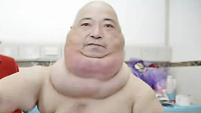 Tumor