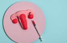 Jerawat Muncul Setelah Pasang IUD? Simak Penjelasan Ahli