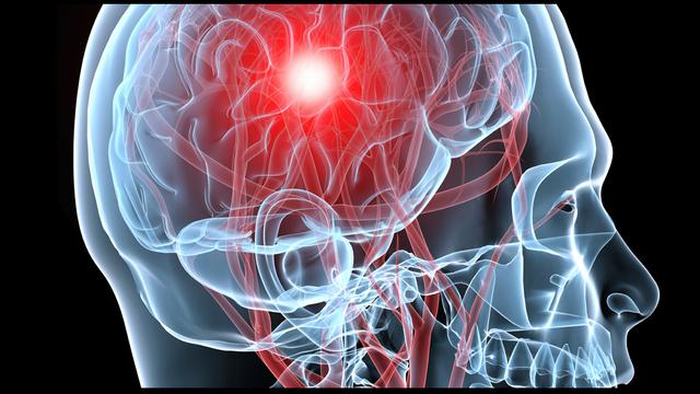 Stroke Bukan Akhir Segalanya Lakukan Tindakan Cepat Health Liputan6 Com