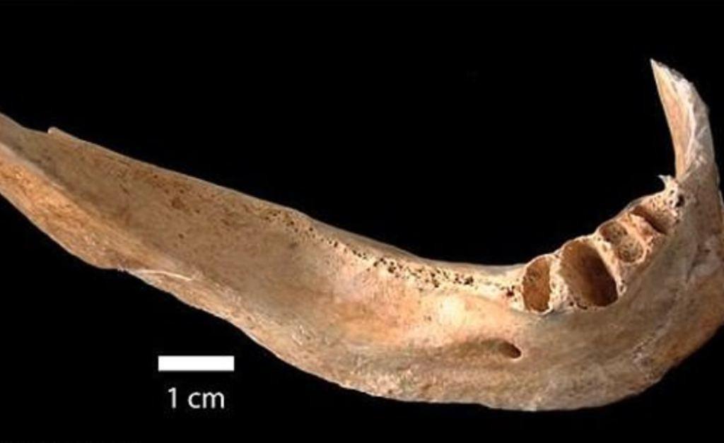 Terkuak Jejak Radiasi Mengerikan Di Tulang Rahang Korban Bom Atom Hiroshima Global Liputan6 Com