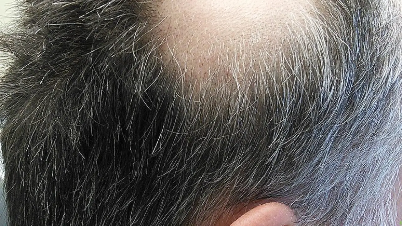 Alopesia