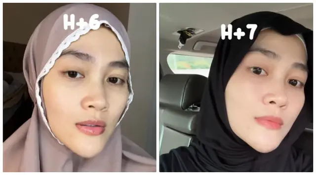 6 Potret tranformasi wajah Henny Rahman istri Alvin Faiz usai perawatan, berubah glowing dan mulus