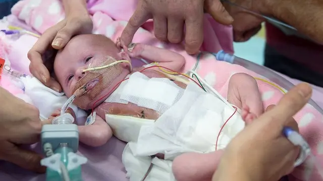 Organ Jantung Keluar Dari Tubuh, Bayi ini Tetap Selamat