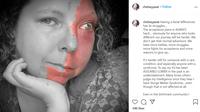 Chelsey Peat, 34, lahir dengan kondisi langka yang disebut Sturge-Weber Syndrome. foto: instagram @Chelseypeat