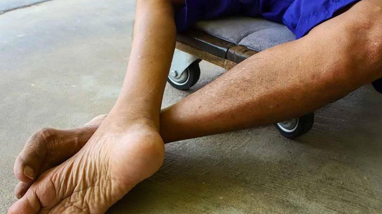 Kenali Perbedaan Kelumpuhan Akibat Polio dan TBC Tulang serta Cara Pencegahannya