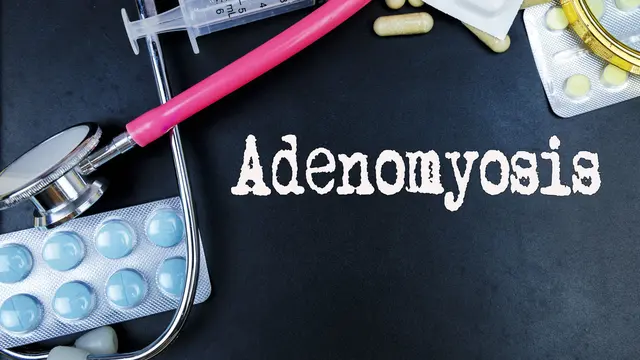 Adenomiosis.