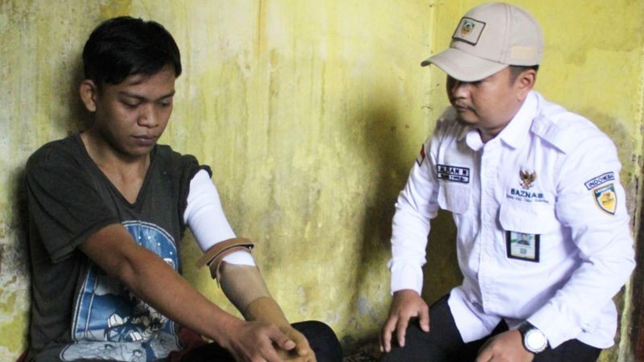 Baznas Salurkan Bantuan Lengan Prostetik untuk Penyandang Disabilitas di Bogor, Tingkatkan Kemandirian