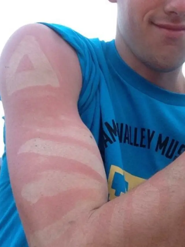 Sunburn Tattoo/Art
