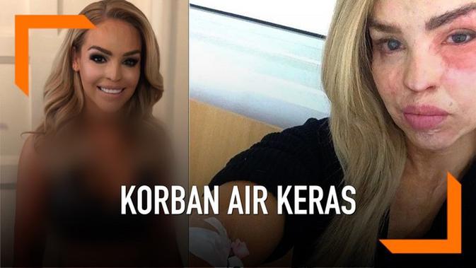VIDEO: Jadi Korban Air Keras, Wanita Ini Jalani 250 Operasi Plastik