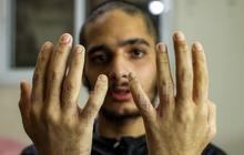 FOTO: Terungkap Kondisi Miris Tahanan Palestina usai Dibebaskan Israel, Tubuh Kurus dan Penuh Kudis