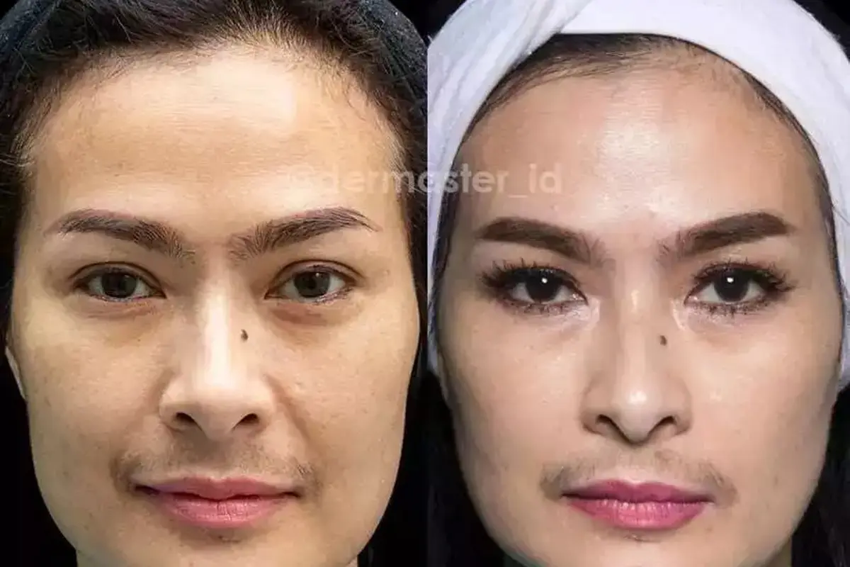 Potret Iis Dahlia sebelum dan sesudah tanam benang (Sumber: Instagram/dermaster_id)