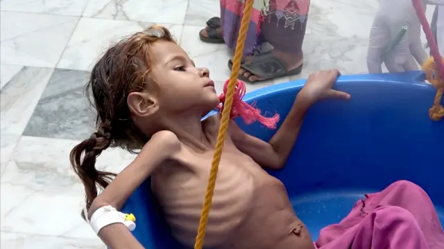 Perang Panjang, 5 Juta Lebih Anak Yaman Terancam Kelaparan Akut