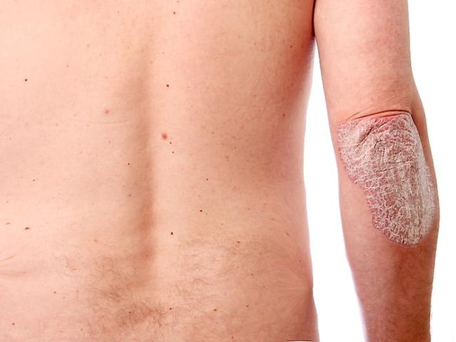 Ketahui 8 Tipe Psoriasis Penyakit Yang Dialami Istri Caisar Yks Health Liputan6 Com