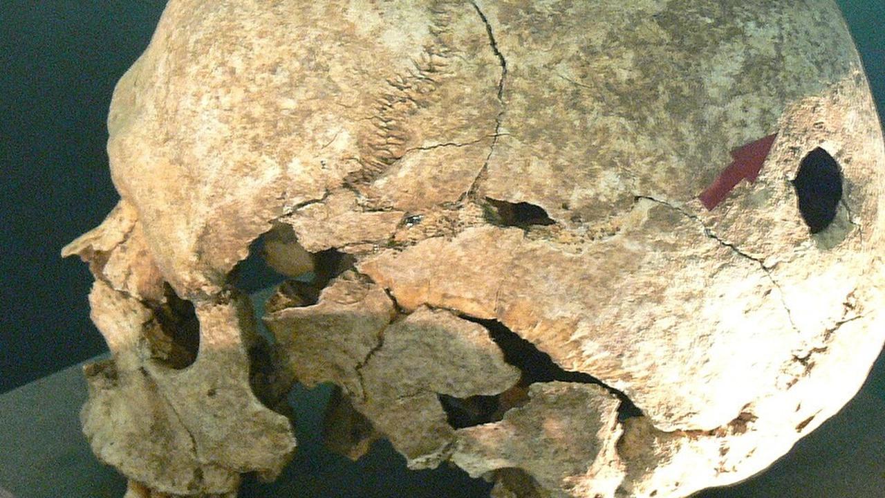 Trepanasi