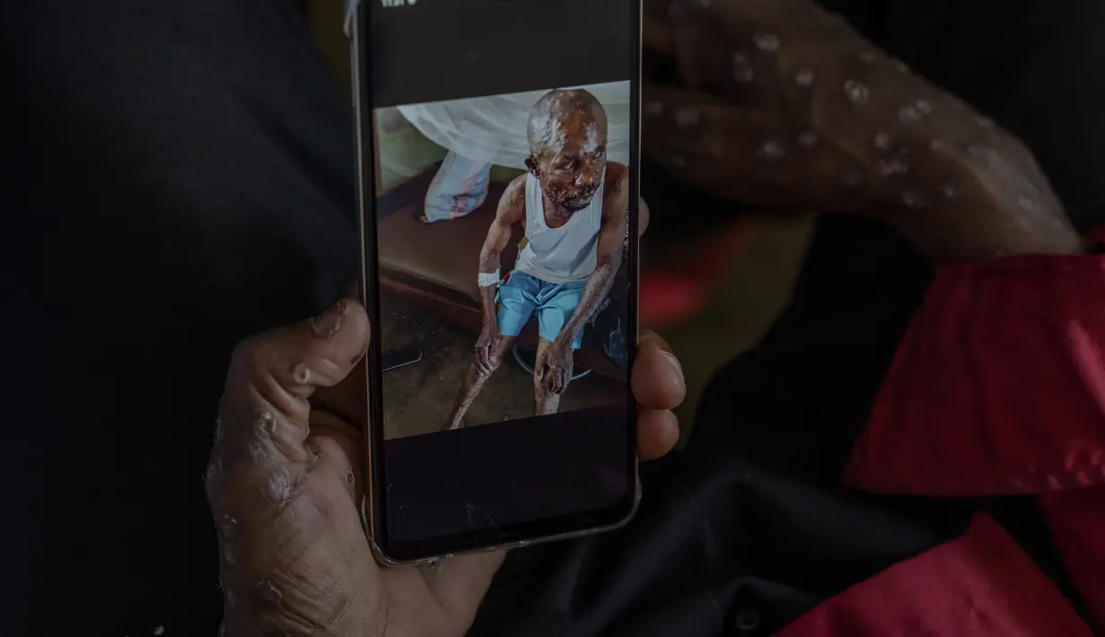 Negara Afrika tengah yang luas, dengan sekitar 100 juta penduduk itu berada di episentrum wabah mpox, dengan kasus dan kematian yang terus meningkat. (AP Photo/Moses Sawasawa)