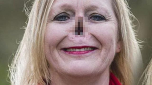 wanita ini kehilangan hidung gara-gara anjing (copyright boldsky.com)