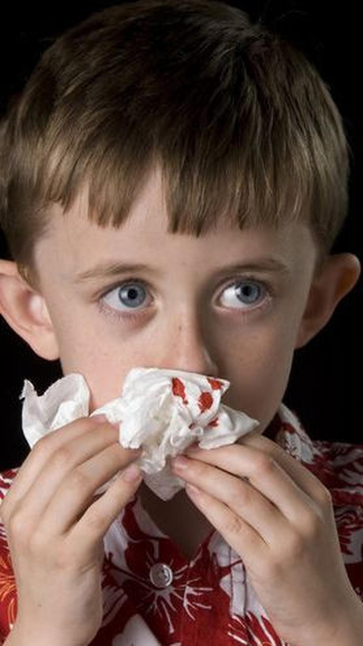 Dengan melakukan langkah-langkah sederhana dan pencegahan yang tepat, mimisan dapat dihindari dan kondisi kesehatan hidung dapat tetap terjaga.