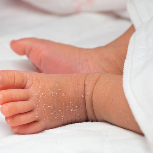 Penyakit Kulit Pada Bayi Yang Paling Umum Terjadi Dan Cara Mengatasinya Hot Liputan6 Com
