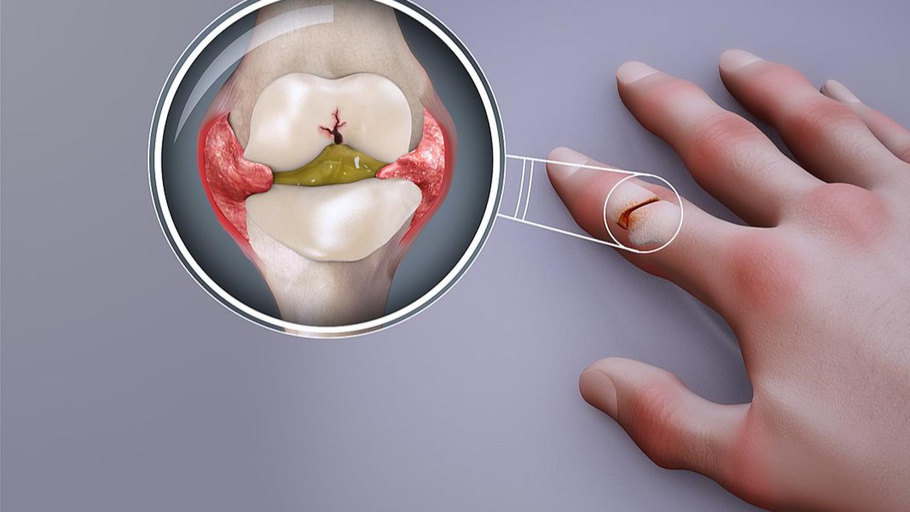 5 Penyebab Rematik Kambuh, Waspadai Makanan yang Memicunya