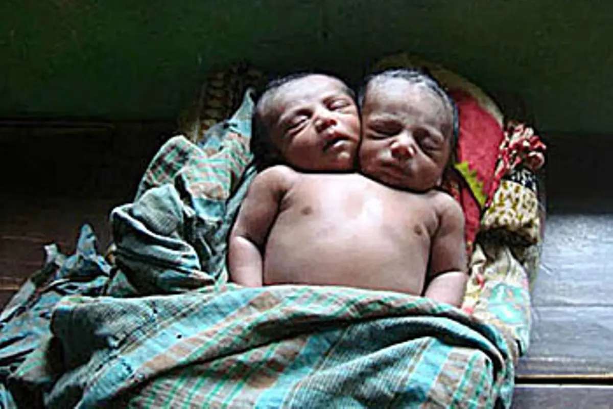 Saling Berbagi Tubuh, Bayi Ini Terlahir dengan Dua Kepala
