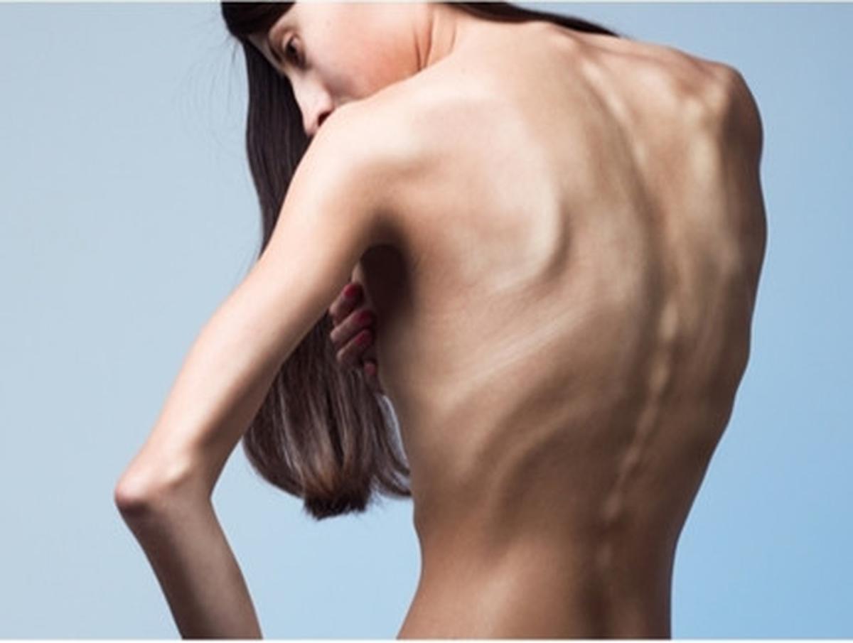 Anoreksia Nervosa, Dampak Buruk Gambar Tubuh atau Body Image Negatif (IV)