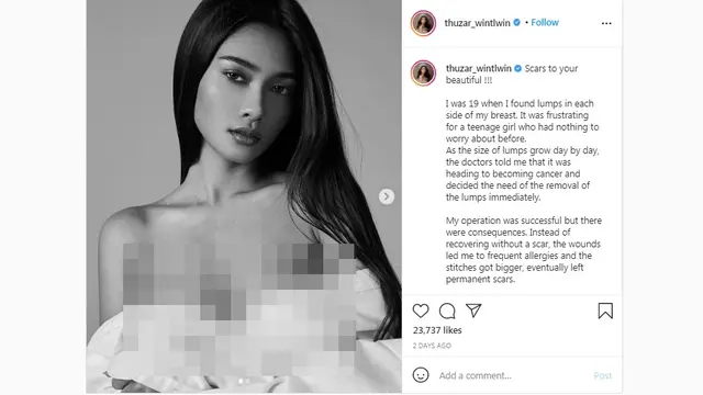 Cerita Miss Universe Myanmar 2020 soal Luka Pasca Operasi Tumor Payudara