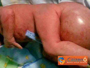 Citizen6, Semarang: Seorang bayi berjenis kelamin perempuan yang dilahirkan keluarga kurang mampu di RSUP Dr Kariadi Semarang mempunyai benjolan berisi cairan sumsum tulang belakang. (Pengirim: Mithcelle Carvin)